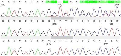 Case report: Heterogeneous mutations of SOX10 gene in a Chinese infant with Waardenburg syndrome type 4C